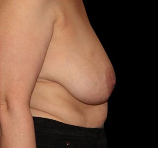 New Jersey Scar-Less Breast Reduction Before & After Gallery - Patient 55432663 - Image 8