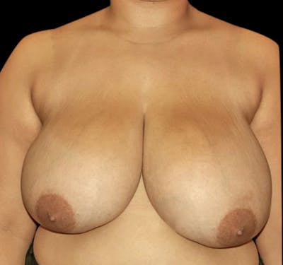 Breast Reduction Before & After Gallery - Patient 55432665 - Image 1