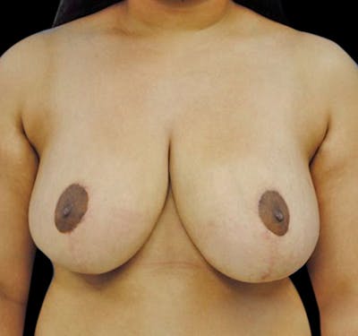 New Jersey Breast Reduction Before & After Gallery - Patient 55432665 - Image 2