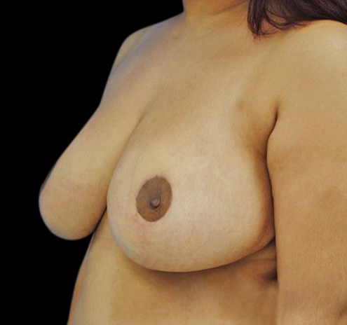 New Jersey Breast Reduction Before & After Gallery - Patient 55432665 - Image 4