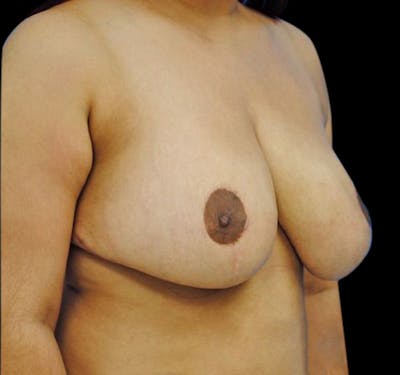 Breast Reduction Before & After Gallery - Patient 55432665 - Image 6