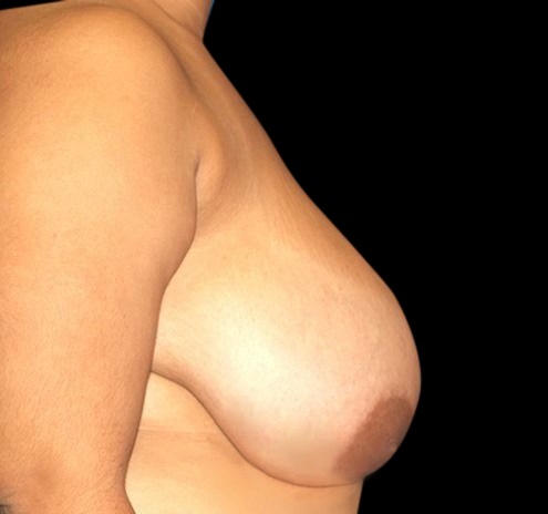 New Jersey Breast Reduction Before & After Gallery - Patient 55432665 - Image 9