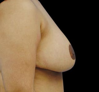 New Jersey Breast Reduction Before & After Gallery - Patient 55432665 - Image 10