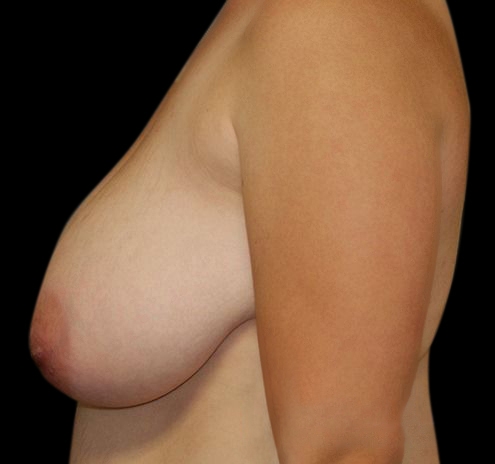 New Jersey Breast Reduction Before & After Gallery - Patient 55432669 - Image 7