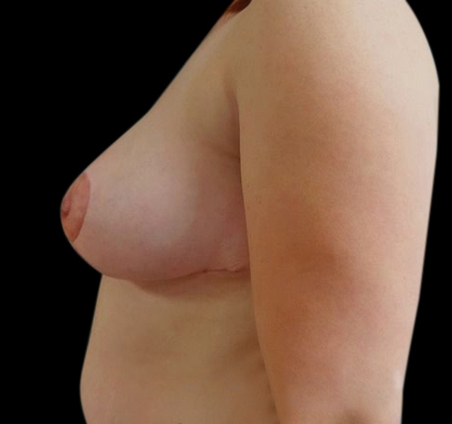 New Jersey Breast Reduction Before & After Gallery - Patient 55432669 - Image 8