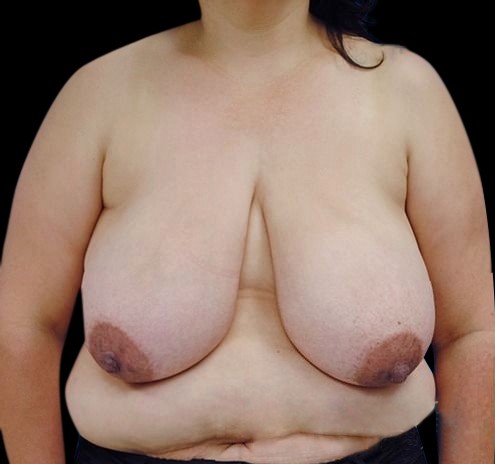 New Jersey Breast Reduction Before & After Gallery - Patient 55432670 - Image 1