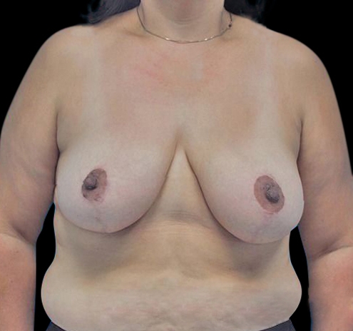 New Jersey Breast Reduction Before & After Gallery - Patient 55432670 - Image 2