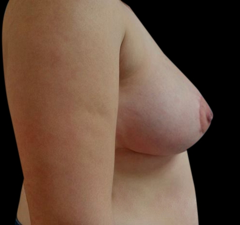 New Jersey Breast Reduction Before & After Gallery - Patient 55432669 - Image 10