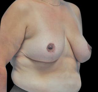 Breast Reduction Before & After Gallery - Patient 55432670 - Image 4