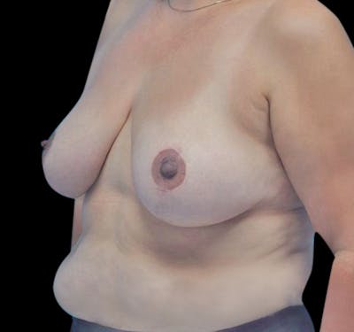 Breast Reduction Before & After Gallery - Patient 55432670 - Image 6