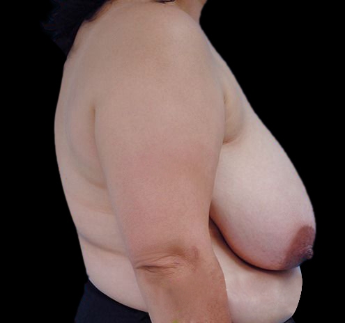 New Jersey Breast Reduction Before & After Gallery - Patient 55432670 - Image 7