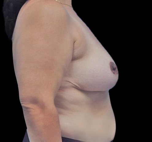 New Jersey Breast Reduction Before & After Gallery - Patient 55432670 - Image 8