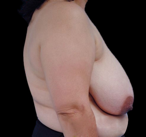New Jersey Breast Reduction Before & After Gallery - Patient 55432670 - Image 9
