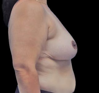 New Jersey Breast Reduction Before & After Gallery - Patient 55432670 - Image 10