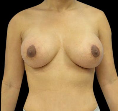 New Jersey Breast Lift (Mastopexy) Before & After Gallery - Patient 55432672 - Image 2