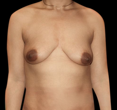 New Jersey Breast Lift (Mastopexy) Before & After Gallery - Patient 55432672 - Image 1