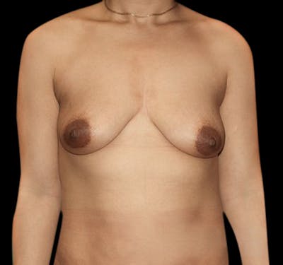 New Jersey Breast Lift (Mastopexy) Before & After Gallery - Patient 55432672 - Image 1