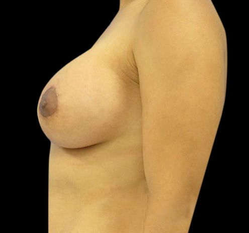 New Jersey Breast Lift (Mastopexy) Before & After Gallery - Patient 55432672 - Image 4