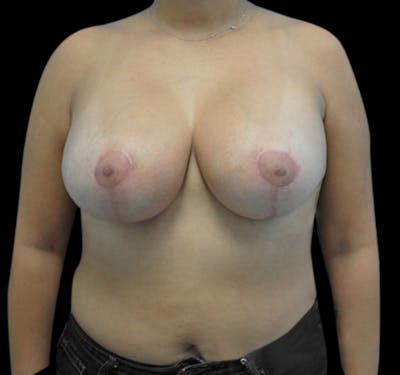 Breast Lift (Mastopexy) Before & After Gallery - Patient 55432673 - Image 2