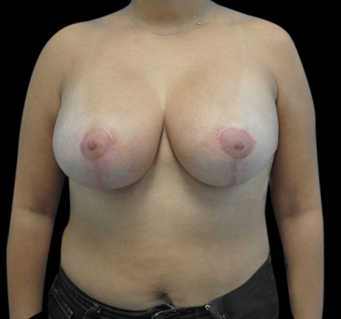 New Jersey Breast Lift (Mastopexy) Before & After Gallery - Patient 55432673 - Image 2