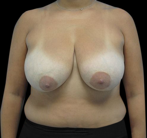 New Jersey Breast Lift (Mastopexy) Before & After Gallery - Patient 55432673 - Image 1