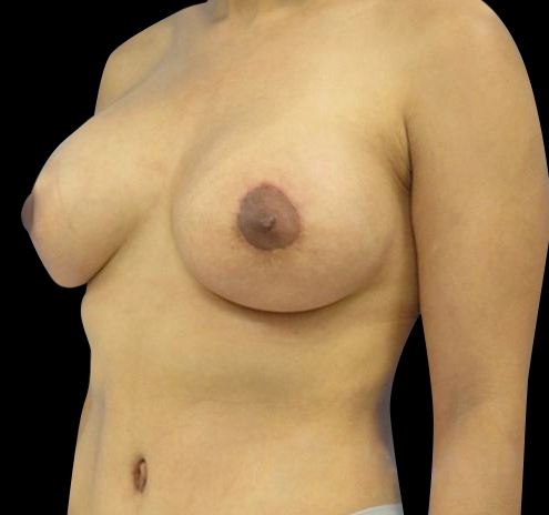 Breast Lift (Mastopexy) Before & After Gallery - Patient 55432672 - Image 8