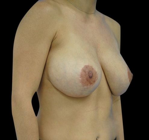 New Jersey Breast Lift (Mastopexy) Before & After Gallery - Patient 55432674 - Image 3