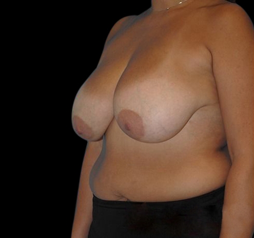 New Jersey Breast Lift (Mastopexy) Before & After Gallery - Patient 55432673 - Image 5