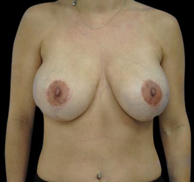 Breast Lift (Mastopexy) Before & After Gallery - Patient 55432674 - Image 1