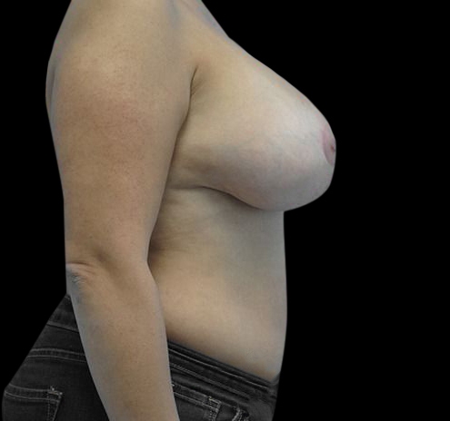 Breast Lift (Mastopexy) Before & After Gallery - Patient 55432673 - Image 8