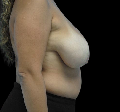 New Jersey Breast Lift (Mastopexy) Before & After Gallery - Patient 55432673 - Image 7