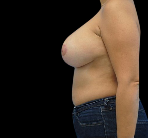 New Jersey Breast Lift (Mastopexy) Before & After Gallery - Patient 55432673 - Image 10