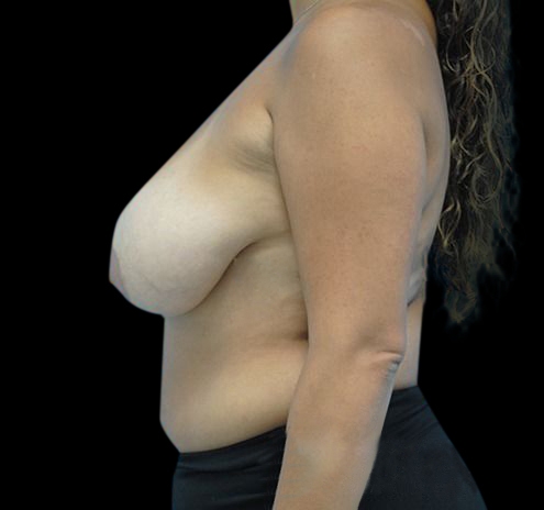 New Jersey Breast Lift (Mastopexy) Before & After Gallery - Patient 55432673 - Image 9