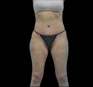New Jersey Body Lift Before & After Gallery - Patient 55432697 - Image 2