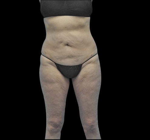 New Jersey Body Lift Before & After Gallery - Patient 55432697 - Image 1