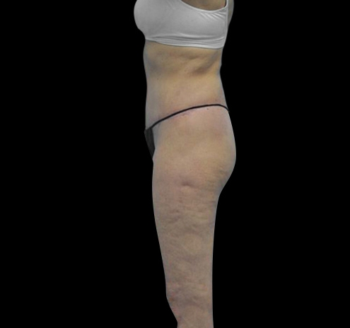 New Jersey Body Lift Before & After Gallery - Patient 55432697 - Image 4