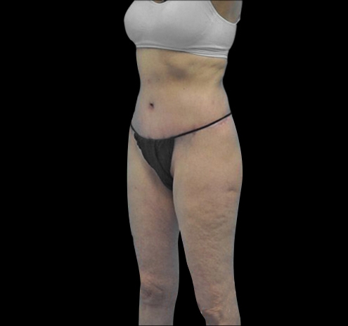 Body Lift Before & After Gallery - Patient 55432697 - Image 6