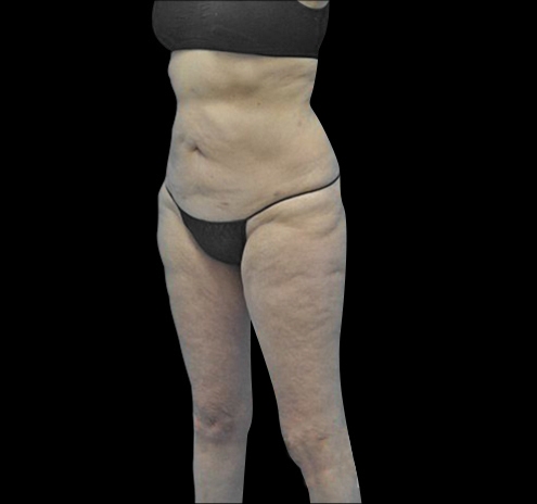 New Jersey Body Lift Before & After Gallery - Patient 55432697 - Image 5