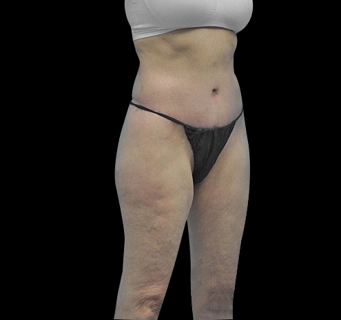 Body Lift Before & After Gallery - Patient 55432697 - Image 8