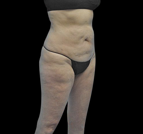 Body Lift Before & After Gallery - Patient 55432697 - Image 7
