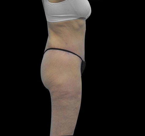 New Jersey Body Lift Before & After Gallery - Patient 55432697 - Image 10