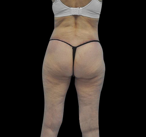 New Jersey Body Lift Before & After Gallery - Patient 55432697 - Image 12