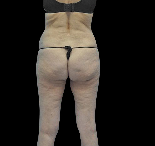New Jersey Body Lift Before & After Gallery - Patient 55432697 - Image 11