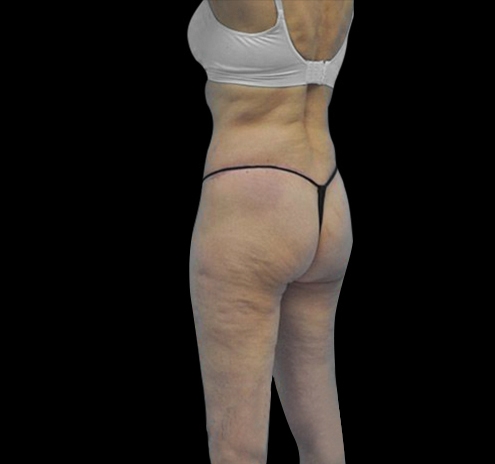 Body Lift Before & After Gallery - Patient 55432697 - Image 14