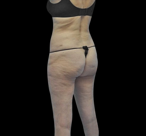 New Jersey Body Lift Before & After Gallery - Patient 55432697 - Image 13