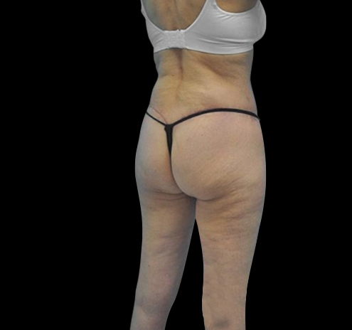 Body Lift Before & After Gallery - Patient 55432697 - Image 16