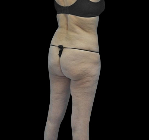 Body Lift Before & After Gallery - Patient 55432697 - Image 15