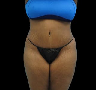New Jersey Tummy Tuck Before & After Gallery - Patient 55432698 - Image 2