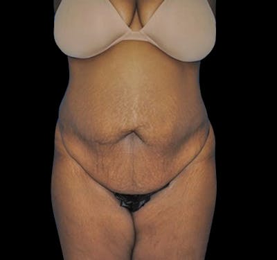 Tummy Tuck Before & After Gallery - Patient 55432698 - Image 1