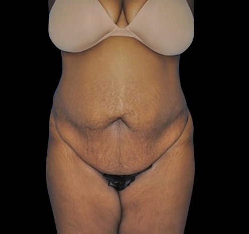New Jersey Tummy Tuck Before & After Gallery - Patient 55432698 - Image 1